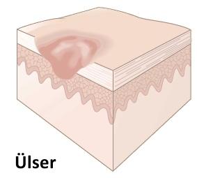 ÜLSER Derinin epidermis ve dermisinin papiller tabakasını da içine alan nekroz sonucu