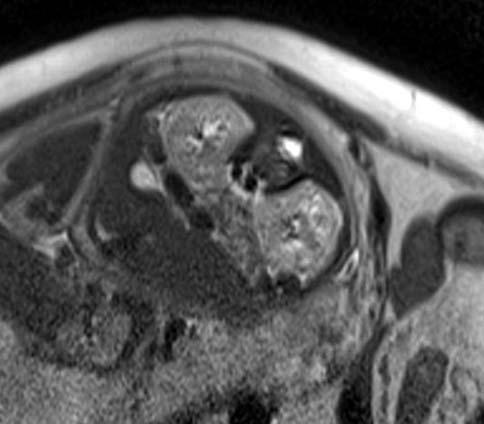 Erifl Yalç n S ve ark. Tart flma Ultrasonografi her zaman antenatal görüntülemenin temelini oluflturacak olsa da fetal MRG prenatal tan da önemi giderek artan yard mc bir yöntemdir.