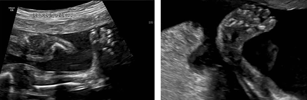 Mid-trimester fetal ultrasonografik taramada pes ekinovarus saptanan hastalar n perinatal ve ortopedik sonuçlar Girifl Talipes veya clubfoot olarak da bilinen konjenital pes ekinovarus (PEV) ard fl k