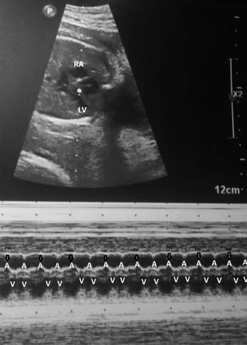 LQTS olas l n kontrol etmek üzere EKG de ebeveyn QT aral klar de erlendirildi ve uzun QT aral klar olmad görüldü (<480 ms). Genetik sonografide ek fetal anomali gözlenmedi. Gebeli in 29.