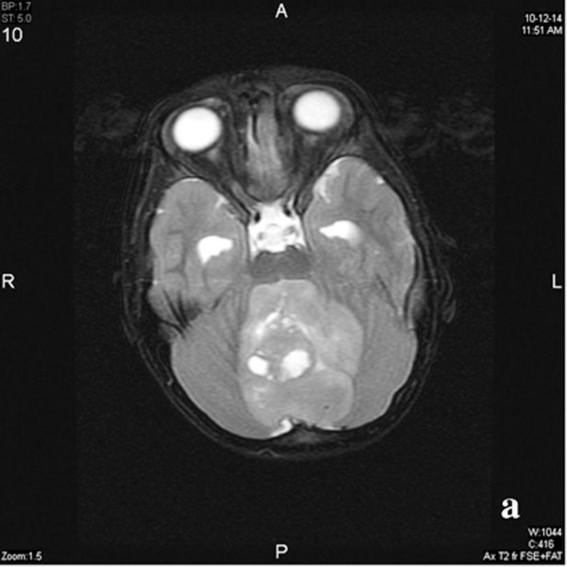 Radyolojik Görüntüleme Şekil. 5 yaşında erkek çocuk. a) Aksiyel T ağırlıklı görüntüde arka fossa yerleşimli IV.