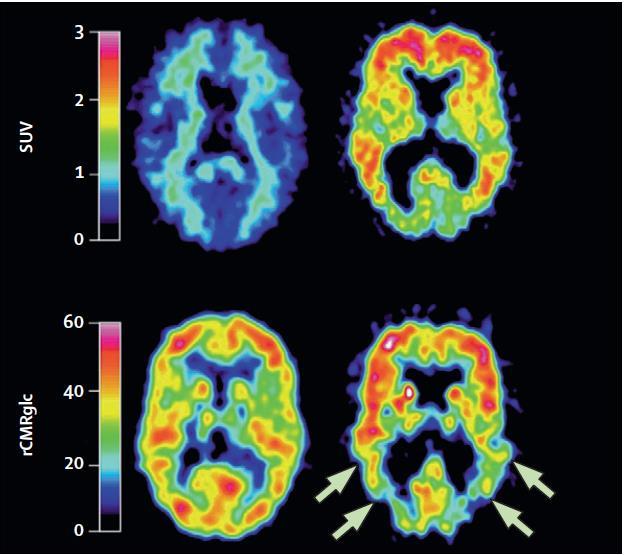 Şekil 2.2. Alzheimer hastası ve sağlıklı bireyden alınan nörolojik görüntüleme.