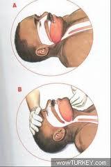 Bebeklerde Temel Yaşam Desteği Uygulama Teknikleri Bebeklerin hava yolu açıklığının sağlanmasında çocuklara göre daha dikkatli davranılmalıdır. Boyun hasarı olasılığı daha yüksektir.
