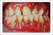 Sindirim Sistemi Hastalıklarına İlişkin Tanısal Terimler Periapical abscess (periapikal apsıs): Diş kökü apsesi.