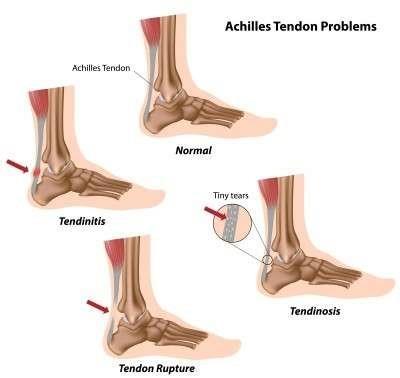 Aşil tendon problemleri Küçük