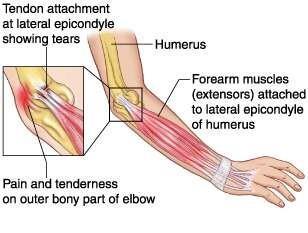 Lateral Epikondilit (tenisçi dirseği) Yan tendon bağlantısında yırtılma Ön kol kasları