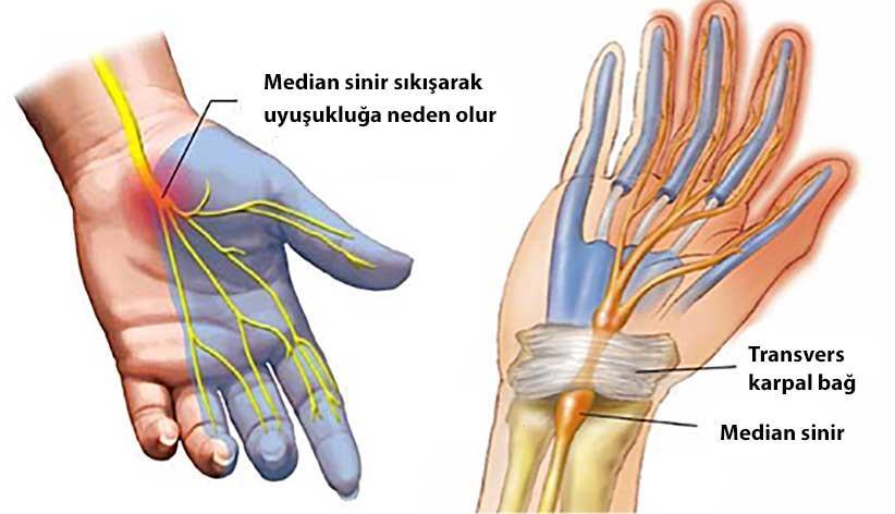 Karpal Tünel Sendromu Çok ve yanlış kullanıma bağlı tendonların etrafındaki kılıflarda meydana gelen inflamasyon ve şişme (tenosinovit) Ödem (çoğunlukla gebelikte oluşur ve karpal tünel içi