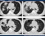 12 İA tanısında akciğer radyolojisi Direk grafi nötropenik hastaların >%50 sinde normal Multi-slice bilgisayarlı tomografi En sık karşılaşılan radyolojik bulgular Nodül (±halo) Hava-hilal görüntüsü