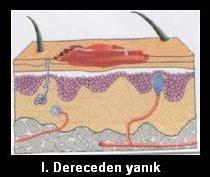 Yanıklar Nasıl Derecelendirilir?