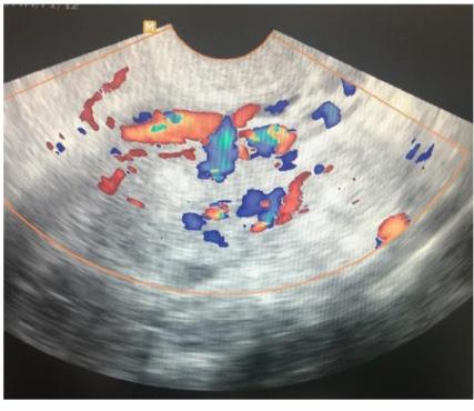 2018 ÇUKUROVA [Abstract:0010] SS-10 [Accepted:Oral Presentation] [Jinekoloji] Tedaviye dirençli anormal uterin kanama: Oldukça nadir uterin arteriyovenöz malformasyon olgusu Servet Gençdal1, Emre