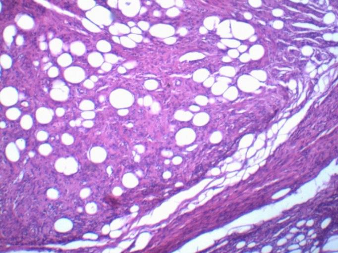 2018 ÇUKUROVA Figure 2 Histopatolojik görüntüde İğsi hücrelerden