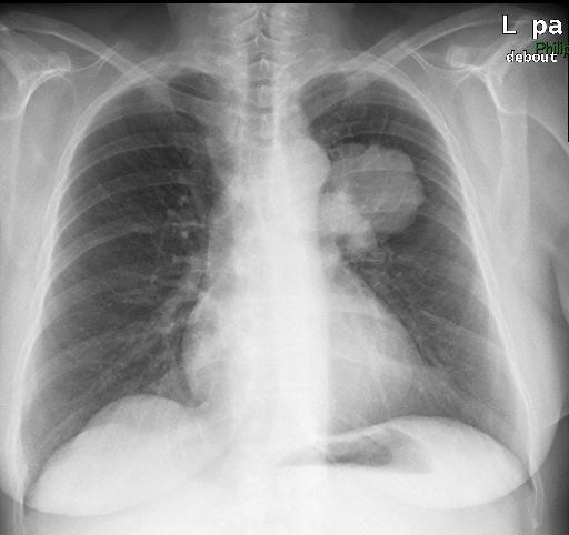 Akciğer Kanserini düşündüren semptomlar Göğüs semptomları Yapısal semptomlar Organ-spesifik semptom (Ör.
