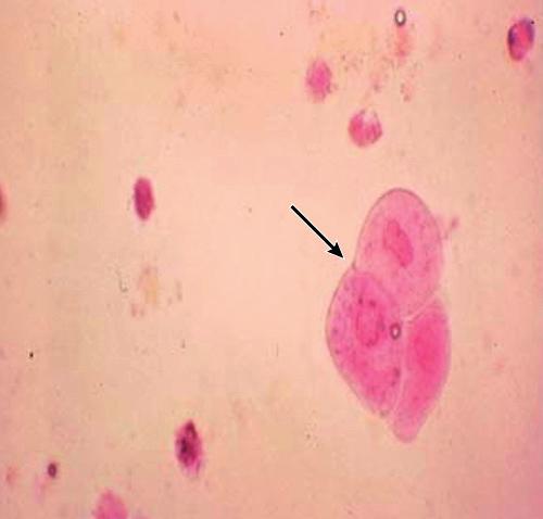 BÖBREK FİZYOPATOLOJİSİ Transisyonel Epitelyal Hücreler Üroepitelyumun dökülmesiyle oluşur (kalikslerden bayanlarda mesane-erkeklerde proksimal üretraya kadar).