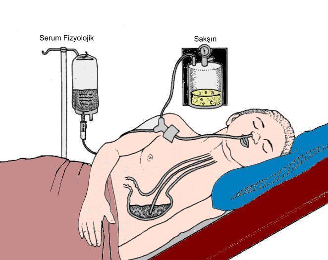 Mide Lavajı Uygulaması Kanamalarda Uygulama Sonda (tüp) hastaya yutturulur. 50-200 ml. buzlu serum fizyolojik solüsyonu verilir.