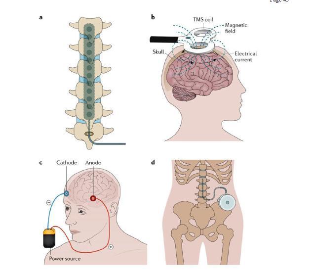 Nöropatik ağrıda girişimsel tedaviler ( Colloca et all) A- SCS (spinal kord stimulatörü) B- TMS