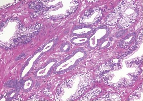 İyi oluşmuş glandüler yapılar Benign glandlardan daha küçük Tek sıralı kuboidal/kısa kolumnar epitel ile döşenme dış bazal hücre tabakası yoktur.