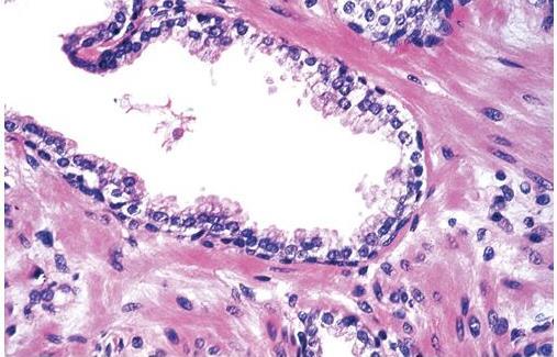 Prostat Histolojisi Normal prostat glandı: Bazal tabaka (alçak kuboidal epitel) Sekretuar tabaka (kolumnar epitel) Küçük papiller çıkıntılar Bol miktarda