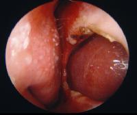 TRAVMATİK NEDENLER Septal hematom: Septum mukoperikondriumu altında (mukoza ile kartilaj arasında) kan birikmesidir.