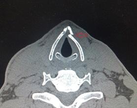 Şekil 3 : Bilgisayarlı boyun tomografi (BT) tetkikinde sol tarafta tiroid kartilaj anterior 1/3 ünde deplase fraktür hattı izlenmekte.