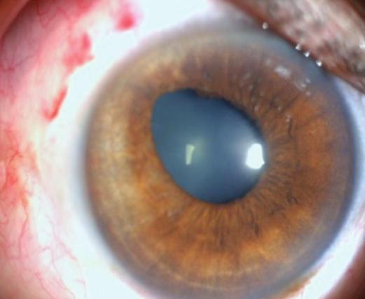 9 Uzun vadede arterlerdeki dolaşım sıklıkla geri döner ancak bazı hastalarda iris atrofisi ve pupil düzensizlikleri sebat edebilir.