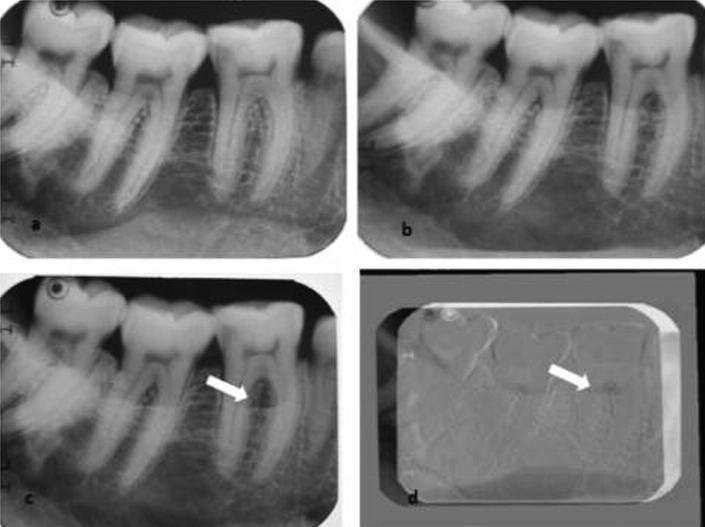 RESİM 4: a) Sağlıklı molar bölgeden konvansiyonel olarak alınan periapikal radyografi; b) 2 mm lik defektli bölgeden konvansiyonel olarak alınan periapikal radyografi; c) 4 mm lik defektli bölgeden
