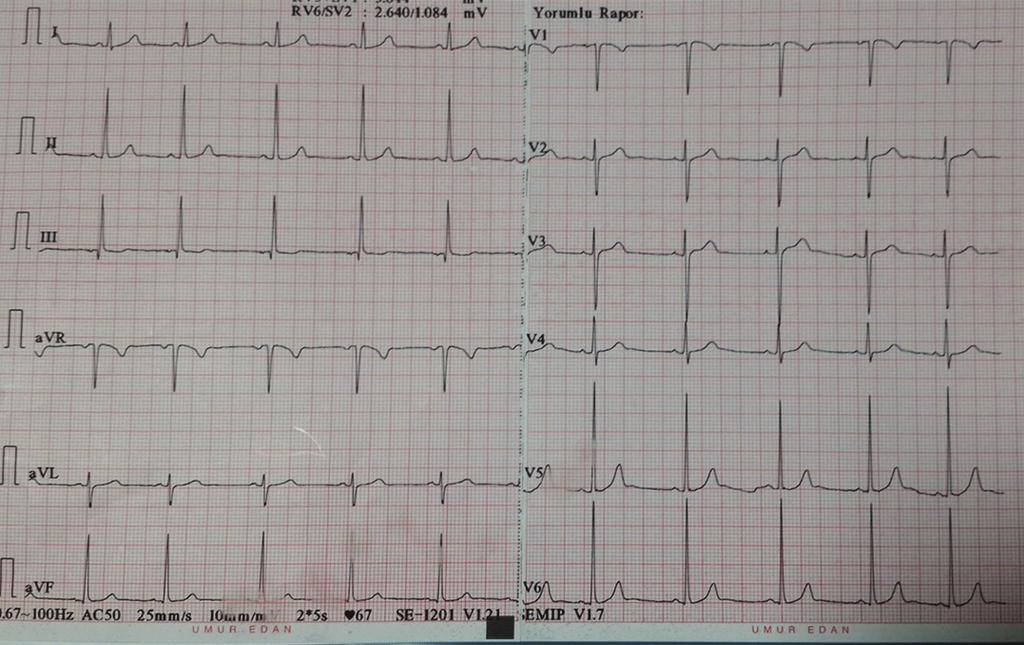 Hasta EKG si çekildikten sonra kısa PRsendromu-WPW sendromu ön tanıları ile kardiyoloji polikliniğine yönlendirildi. Hastaya kardiyoloji uzmanı tarafından ritm Holter cihazı takıldı.