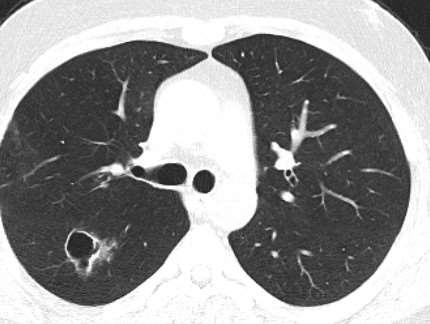 TARTIŞMA: Vaskülitlerin seyrinde akciğer tutulumu gözlenebilir.pulmoner hemoraji daha çok ANCA ilişkili vaskülitlerde görülür.