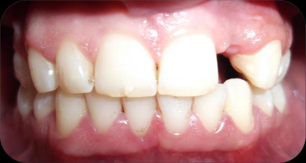 micro-filler composites were used to cover substructure. 6,9 In dentistry, carbon-graphite, aramid, polyethylene and glass were used as fibre constitution in FRC.