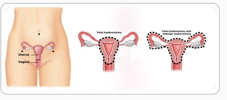 1 - MAKALELERDEN SEÇMELER Removal of all ovarian tissue versus conserving ovarian tissue at time of hysterectomy in premenopausal patients with benign disease: study using routine data and data