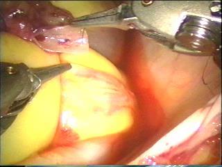 TECAB (Robot ile Ameliyat) totally endoscopic coronary artery