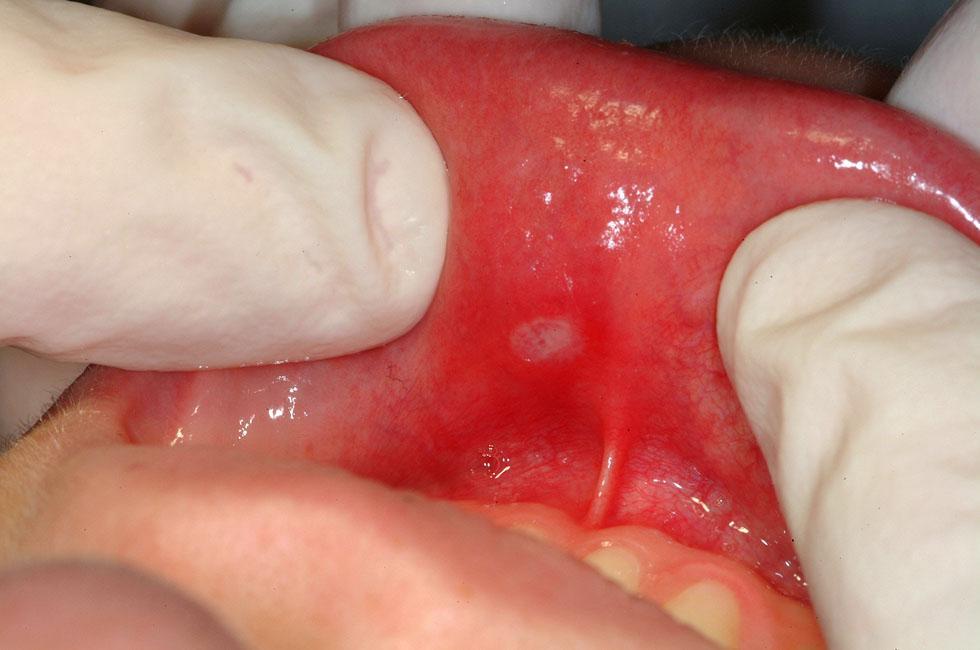 PFAPA Periodic Fever Aphthous Ateş Stomatitis Pharyngitis Adenitis Servikal lenfadenopati (%88) Farenjit (%70-78) Aftöz