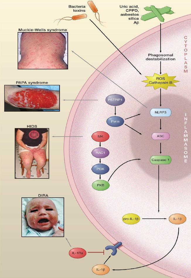 İdiopatik: PFAPA Otozomal resesif Ailevi Akdeniz ateşi Hiper-IgD ve periyodik ateş sendromu IL-1R antagonist eksikliği (DIRA) Otozomal dominant TNF reseptörü ile ilişkili periyodik sendrom (TRAPS)