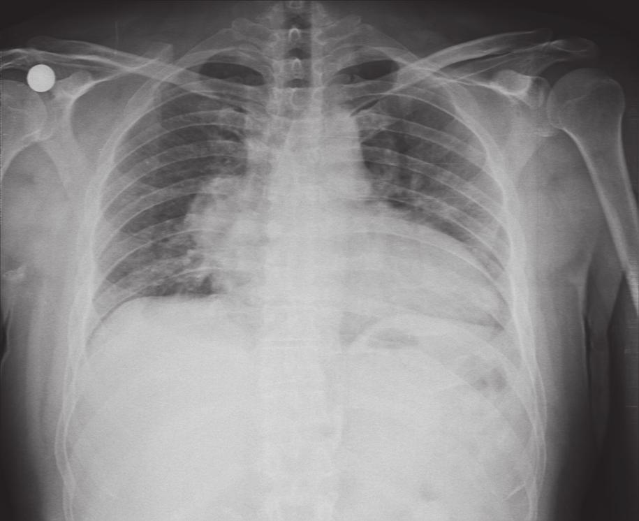 Toraks BT mediasten penceresi kesitinde sağ akciğer alt lob süperior segmentte plevra tabanlı kitle lezyonu Periferik ve biokimyasal kan değerleri normal olan hastanın