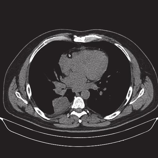 PET/CT incelemesinde lezyonun yüksek 18FDG tuttuğu görüldü (Resim 10, 11). Aynı zamanda multipl karaciğer ve beyin metastazları saptandı. Resim 9.