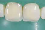 kullanılabilmektedir Klinik vakalar 14, 15 no lu dişlerde sekonder çürük nedeniyle dolguların yenilenmesi Kaynak: Dr.