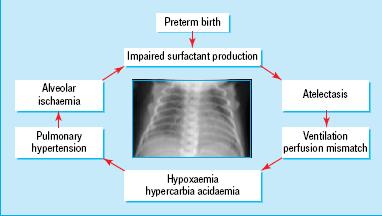 RDS- Hatırlatma (Fizyopatoloji) Preterm doğum Bozulmuş sürfaktan yapımı Alveoler iskemi