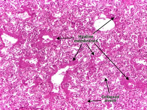 RDS- Hatırlatma (Patoloji) Makroskopik: Akciğer az havalanır; kırmızı renkte, sert ve lastik kıvamında; karaciğere benzer ve suda yüzmez Mikroskopik: Alveoler epiteliyal nekroz epiteliyal hücrelerin