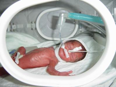 RESPİRATUVAR DİSTRES SENDROMU (RDS) RDS preterm doğum ile ilişkili en önemli pulmoner morbidite En önemli neonatal