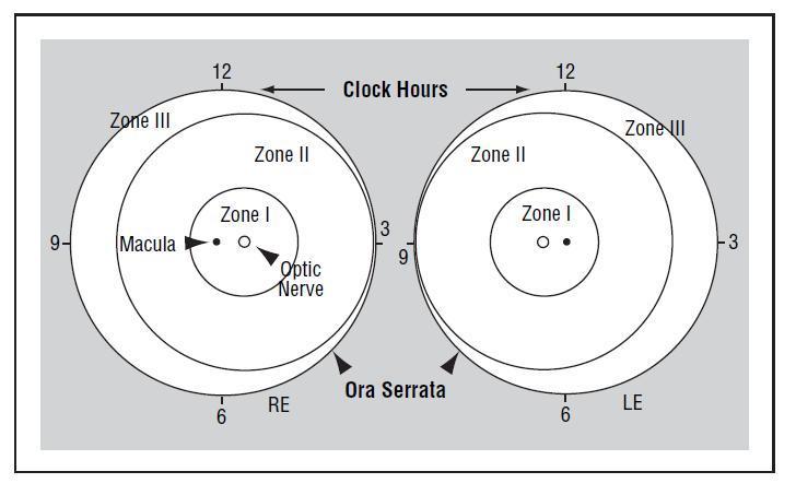 IC-ROP : Lokalizasyon ve Yaygınlık Zon I Zon II Merkezi optik sinir ve yarı çapı optik sinir ile makula arasındaki mesafenin 2 katı olan daire alanı Zon I in kenarından nazal oro serrataya kadar