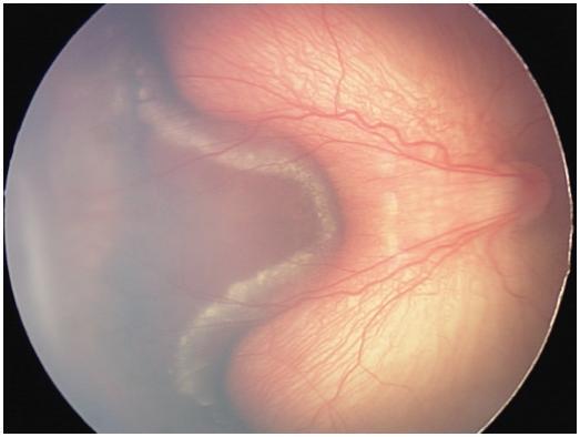 ROP-Evre 4B Parsiyel retinal dekolman: retina ve makulanın