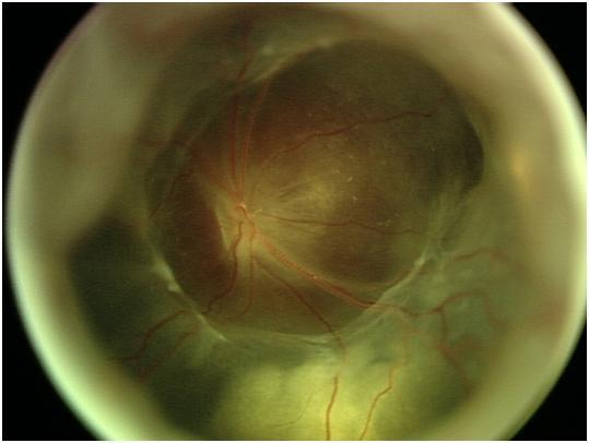 ROP-Evre 5 Tam retinal dekolman, tipik olarak huni görünümündedir.