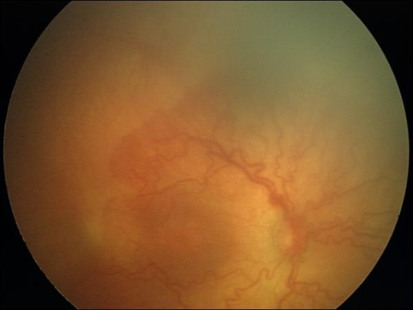 Agresif Posterior ROP-APROP APROP retinal yüzeyde düz olarak bulunan