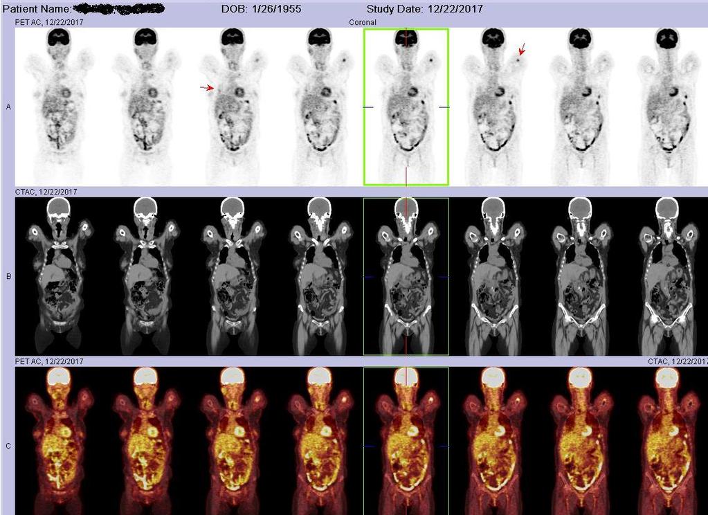 12/2017 PET-CT