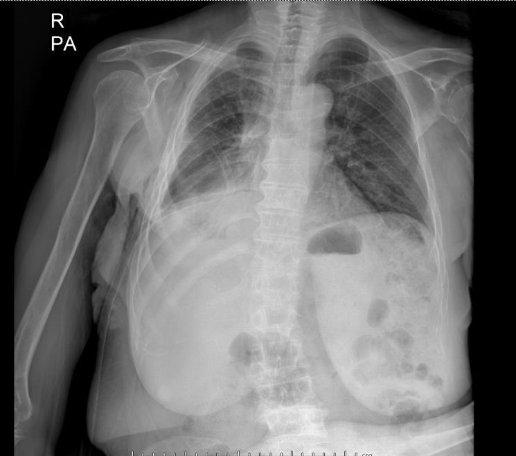 Hastanın Son Durumu Osimertinib 80 mg /gün alıyor Sağ plevral