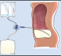 Peritonit peritoneal diyaliz komplikasyonu Tedavide intraperitoneal uygulama