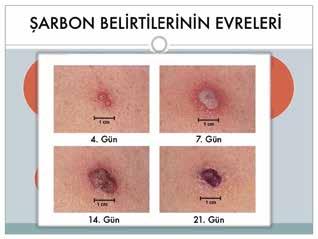 Șarbon Çeșitleri ve Belirtileri Akciğer, deri ve sindirim sistemi șarbonu olmak üzere 3 tip șarbon hastalığı vardır.