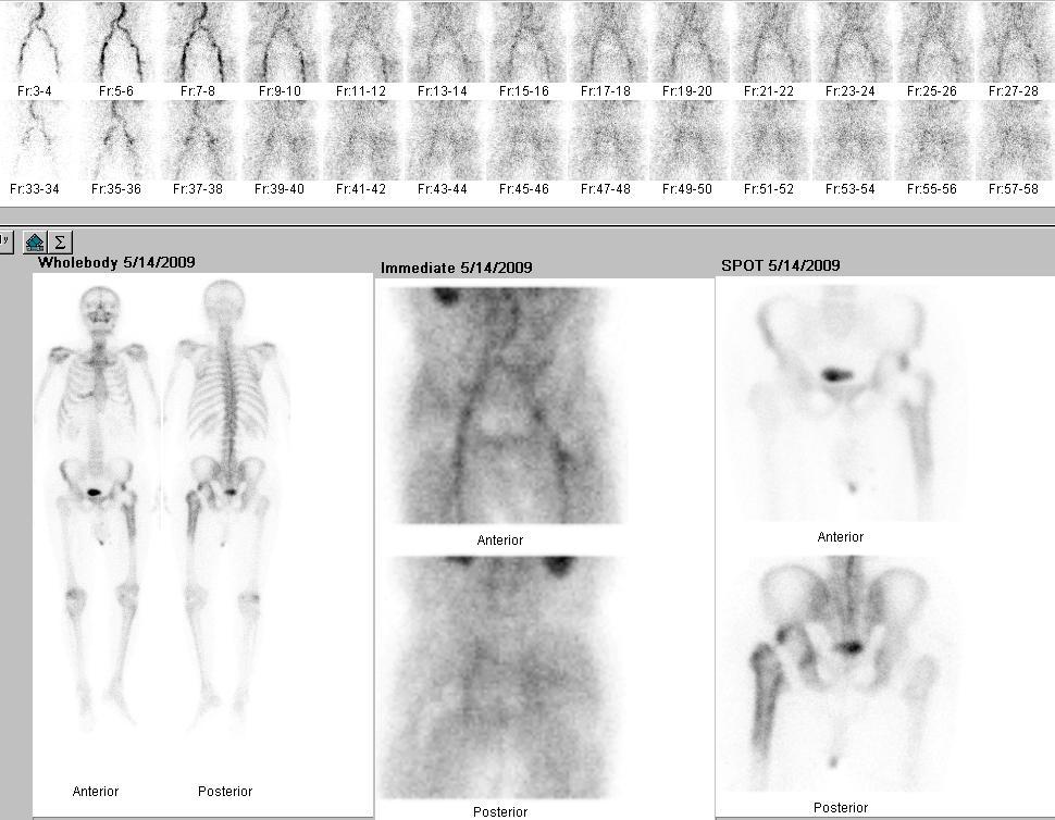 Resim 2a. Grup I, 10 nolu hastanın üç fazlı Ks görüntüsü. Dinamik faz normaldir.