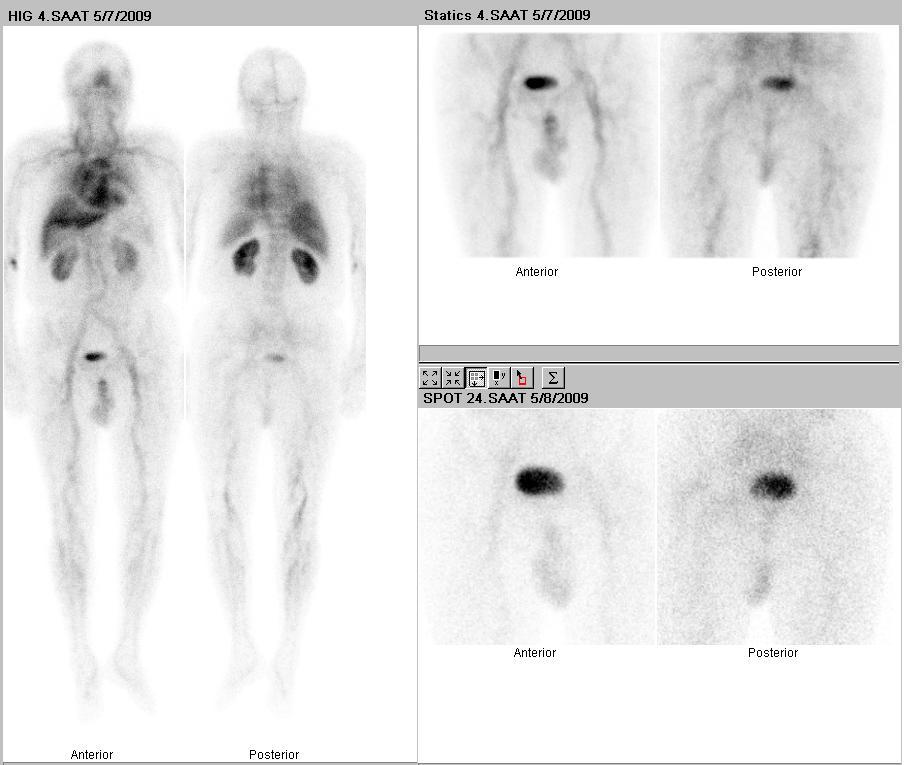 48 Resim 2c.1Grup I, 10 nolu hastanın HIGs görüntüsü. Patolojik radyotraser uptake i izlenmemiştir. Resim 2.1Grup I, 10 nolu hasta (sol kalça protezli) nın sintigrafi görüntüleri.