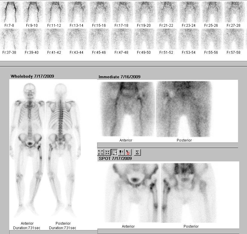 Resim 3a. Grup I, 8 nolu hastanın üç fazlı Ks görüntüsü. Dinamik görüntüler normaldir.