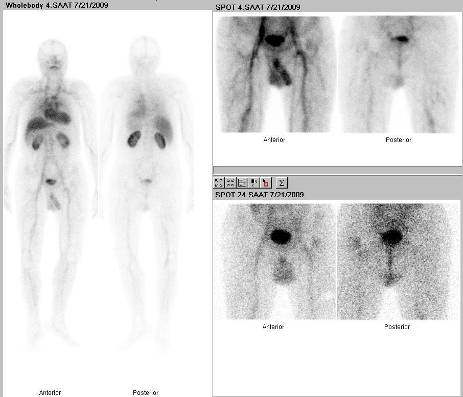 51 Resim 3c. Grup I, 8 nolu hastanın HIGs görüntüsü. Sol kalça protezine uyan alanda geç görüntülerde belirginleşen patolojik radyotraser uptake i izlenmiştir. Resim 3. Grup I, 8 nolu hasta (sol kalça protezli) nın sintigrafi görüntüleri.